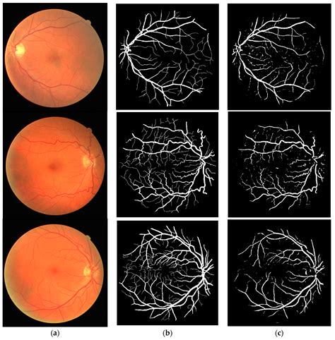 Symmetry Free Full Text A Retinal Vessel Detection Approach Based