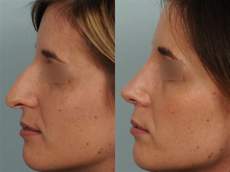 Photos avant et après des différents types de rhinoplasties