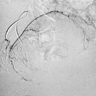 The Right Superior Vesical Artery Was Embolized Using 2 ML Of 300 500