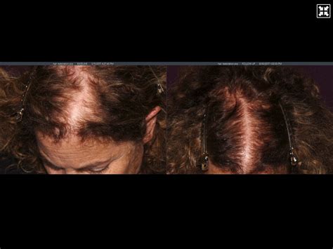 Prp Hair Restoration Before And After Pictures Halo