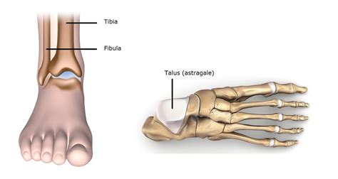 Fracture de la malléole causes diagnostic et traitement