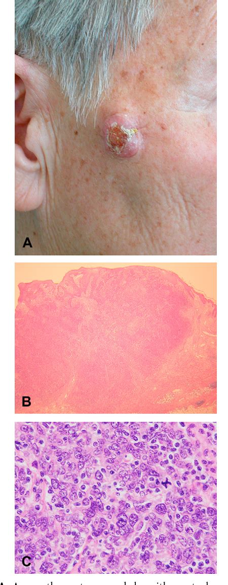 Figure From A Case Of Lymphoepithelioma Like Carcinoma Of The Skin