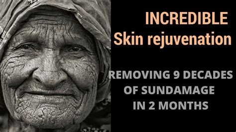 Skin Transformation 9 Decades Of Sun Damage YouTube