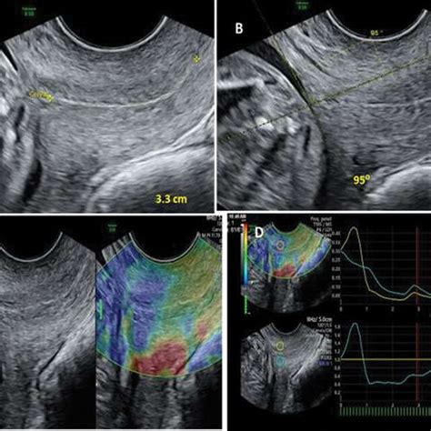 Patient Transvaginal Ultrasound Was Done Cervical Length