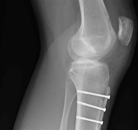 kneecap dislocation knee cap surgeon london expert knee