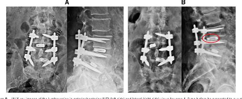 Figure From Full Endoscopic Uniportal Revision Surgery For Removal Of