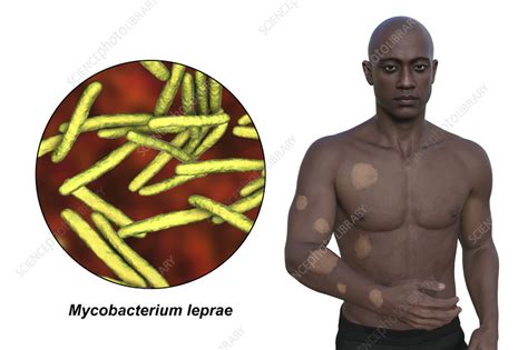 Tuberculoid leprosy, illustration - Stock Image - F042/6892 - Science ...