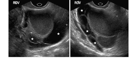 Transvaginal Ultrasound Images Showing Typical Features Of A Right