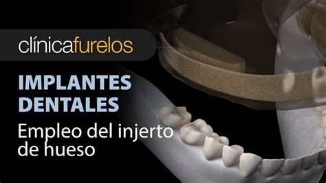 El Injerto De Hueso En La Colocacion De Implantes Dentales YouTube