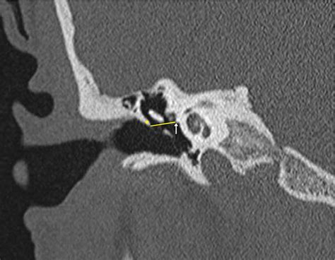 Scutum Temporal Bone