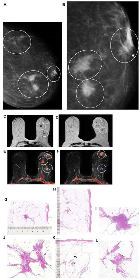 Right Breast Craniocaudal Projection A And Microfocus Magnification