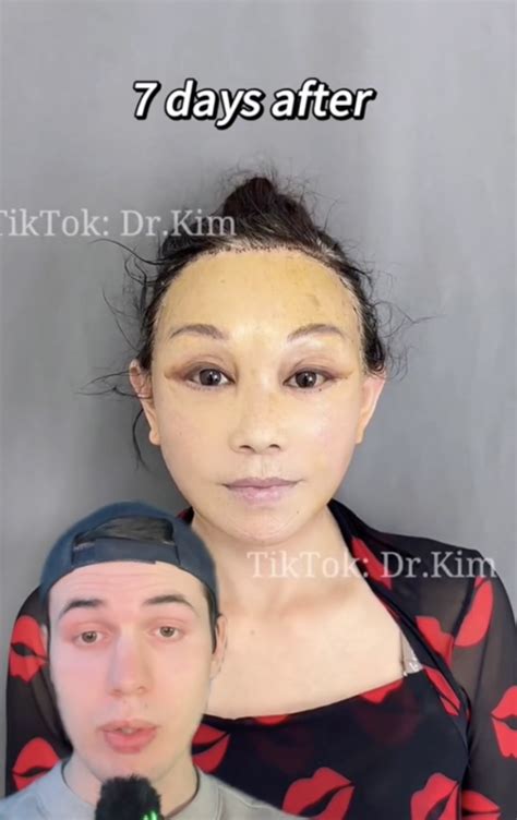 Who Is Dr Kim Plastic Surgeon Tiktok Alleged Scary Facelift Surgeries