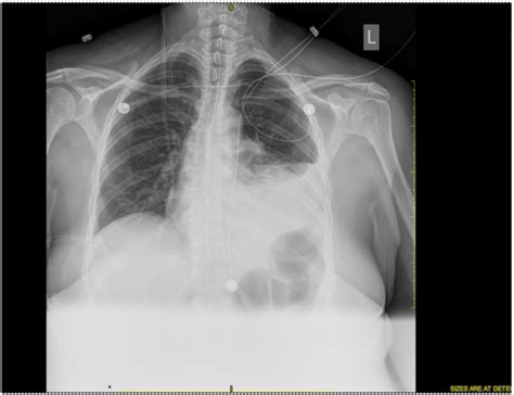 Chest X-ray of left sided pneumothorax. | Download Scientific Diagram