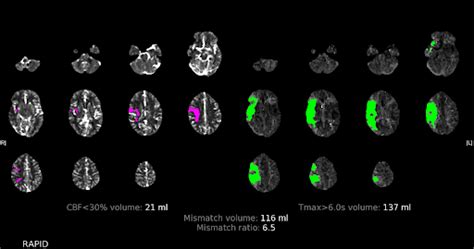 Emergency Guide To Stroke Neuroimaging — Nuem Blog