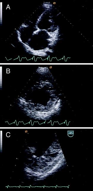 Transthoracic Echocardiogram A Apical Four Chamber And B