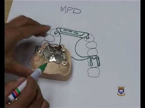 Maxillary Partial Denture Design