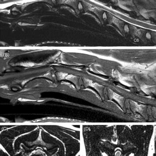 Sagittal T A And T Weighted B And Transverse T Weighted C D