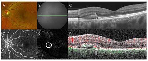 Diagnostics Free Full Text Oct And Oct Angiography Update Clinical