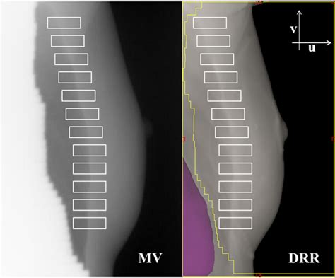 Example Of An Mv Image And Digitally Reconstructed Radiograph Drr For