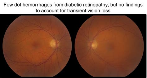 Transient Vision Loss Case Based Neuro Ophthalmology