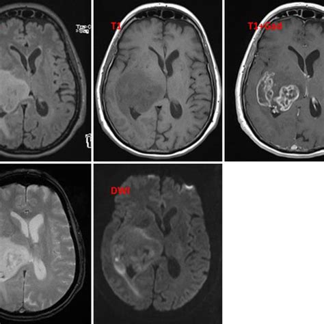 Case 2 MRI Another 2 Years Later Reveals The Known White Matter Lesion