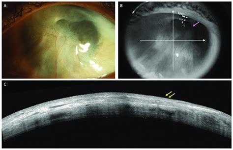 A C Clinical Images Of The Left Eye Of A Patient With Limbal Stem