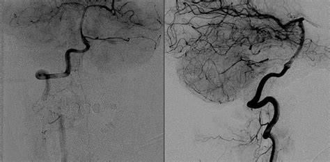 Archives Foramen Magnum Preoperative Embolization Particles And Nbca