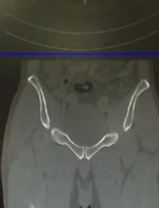 Greater Trochanter Fracture – Healthy Life Med