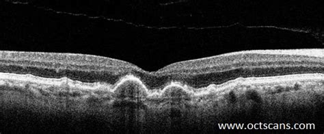 Age-Related Macular Degeneration - Optical Coherence Tomography Scans