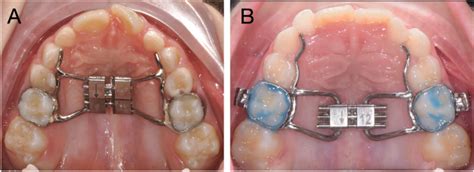 Comparison Of The Skeletal Dentoalveolar And Periodontal Changes