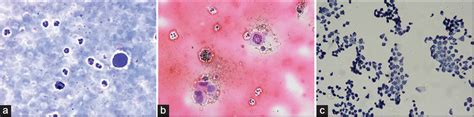 Cytopathology Of Neoplastic Meningitis A Series Of 66 Cases From A Tertiary Care Center