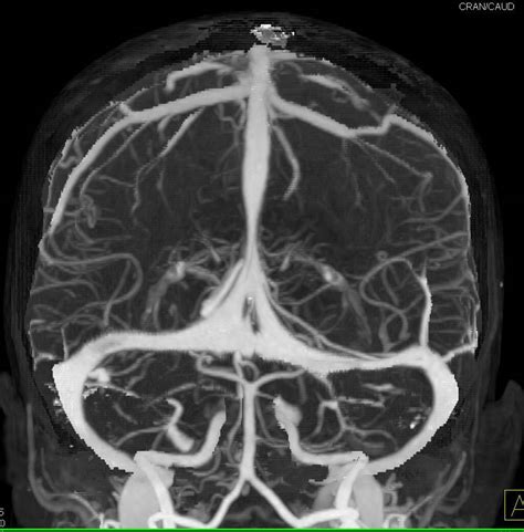 CT Venogram with Dual Energy Bone Removal - Neuro Case Studies - CTisus CT Scanning