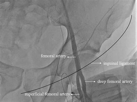 High bifurcation of bilateral deep femoral artery (DFA) angiographic ...