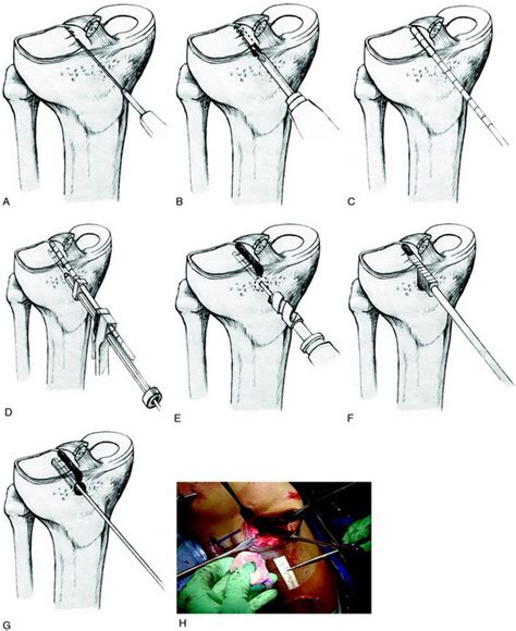 Meniscus Transplantation Diagnosis Operative Techniques And Clinical