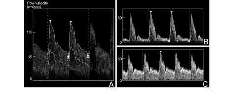 A B Ultrasonograms Of The Right Superficial Temporal Artery Sta On Download Scientific