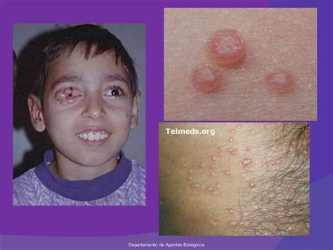 16 Virus Molusco Contagioso