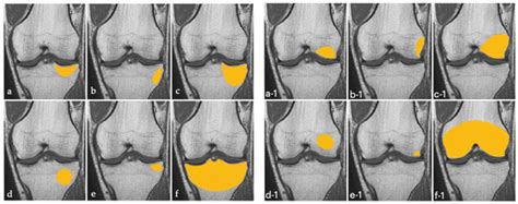 Jcm Free Full Text Is Primary Bone Marrow Edema Of The Knee