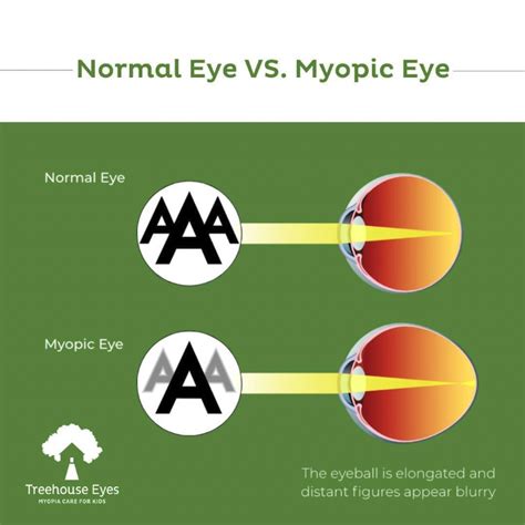 Myopia (nearsightedness): A Pervasive Disease - Insight Vision Center ...