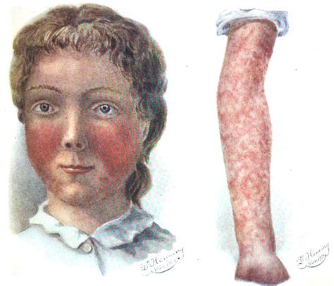 Fifth Disease • Litfl • Medical Eponym Library