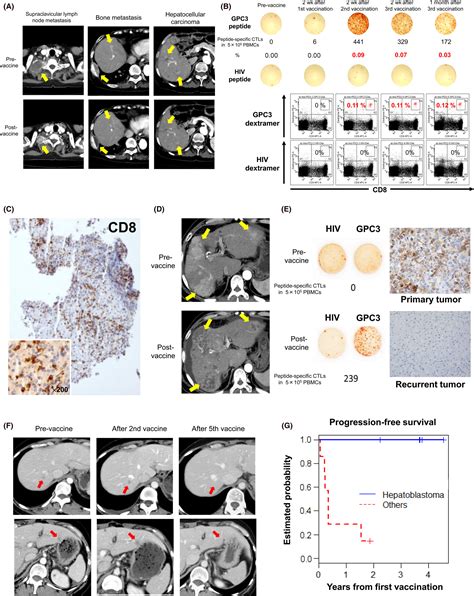 Cancer Immunotherapy‐targeted Glypican‐3 Or Neoantigens Shimizu 2018 Cancer Science