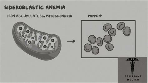 Sideroblastic Anemias Diagnosistreatmentanimated Lecture Sideroblasticanemia