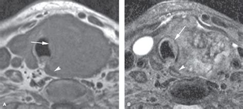 Thyroid Cancer Oncohema Key