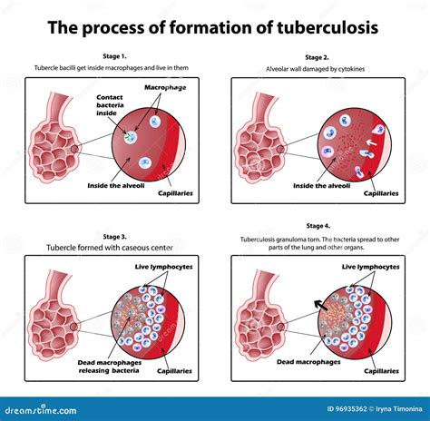 The Process Of Tuberculosis Formation Infographics Vector