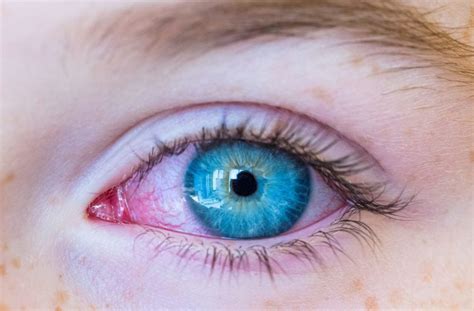 What Can Cause Red Eyes in a Child? | Calgary