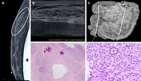 Update On Lobular Neoplasia RadioGraphics