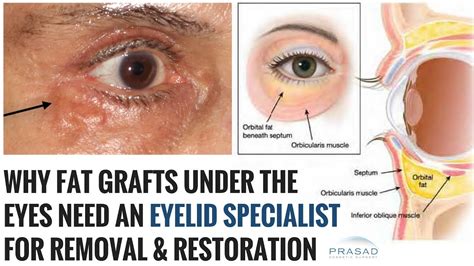 Removal Of Grafted Fat Under The Eyes And Lower Eyelid Restoration By