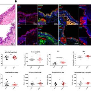 Bronchial epithelial remodeling in rs16969968 α5SNP COPD patients