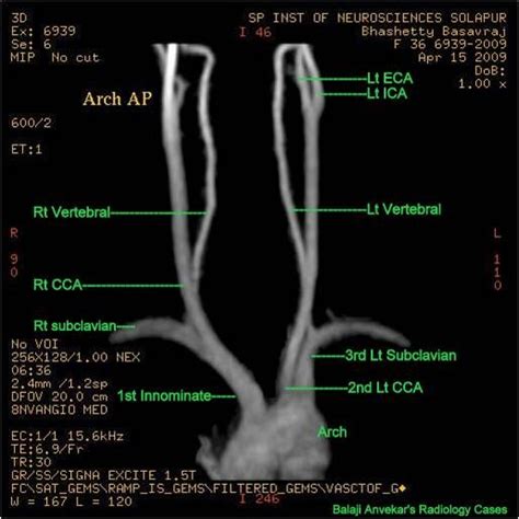 Neuroradiology Cases Normal Mr Angio Brain And Neck Diagnostic