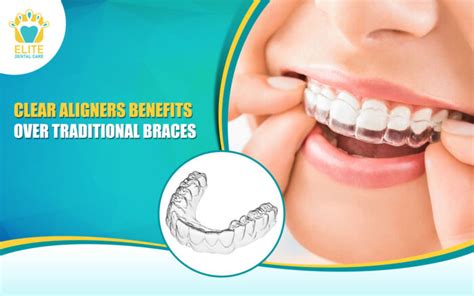 Clear Aligners Benefits Over Traditional Braces Elite Dental Care