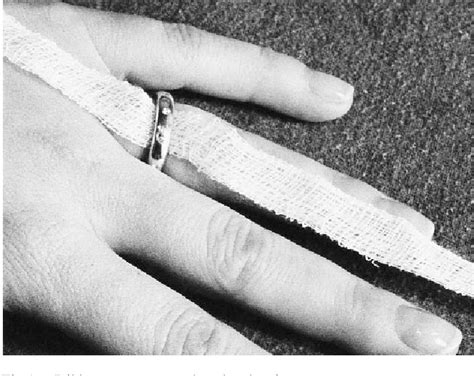 figure    improved method  ring removal semantic scholar